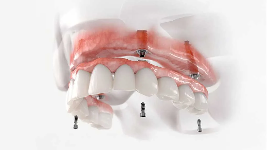 All-on-4 Dental Implants