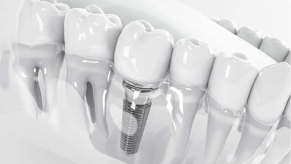 Dental Implants