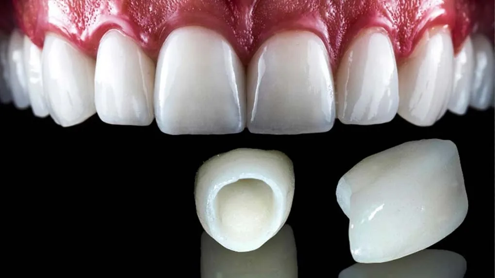 E-max Veneers